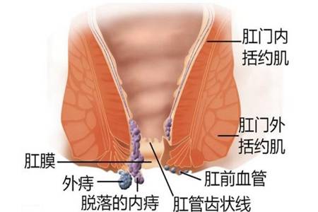 痔疮是怎么引起的？痔疮最佳的自愈方法